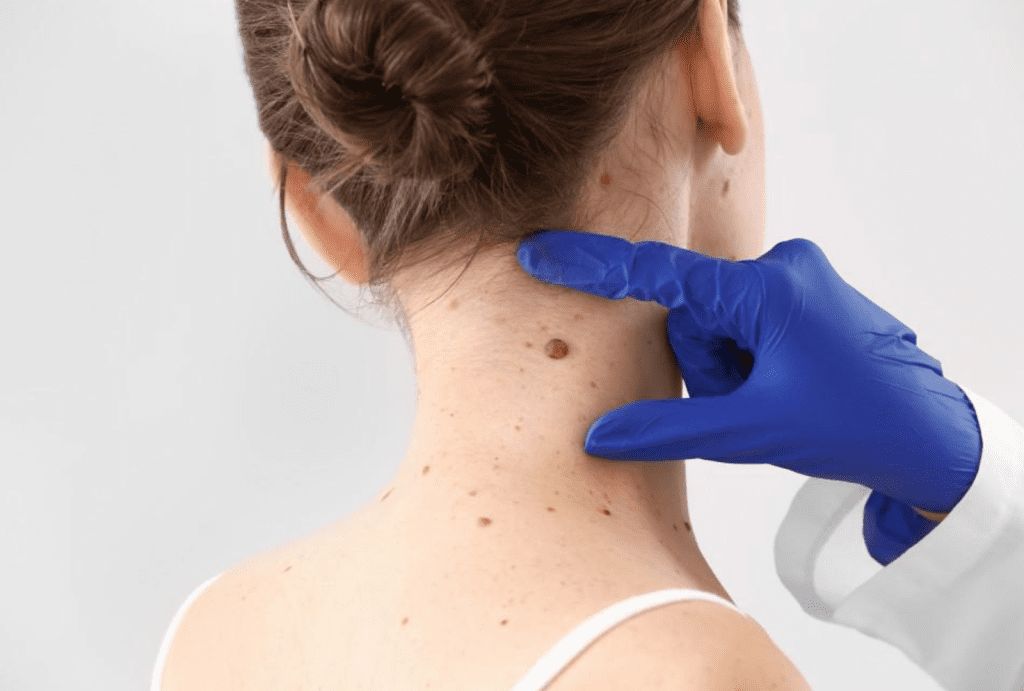 skin tag