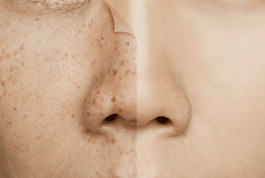 perbedaan melasma dan flek hitam