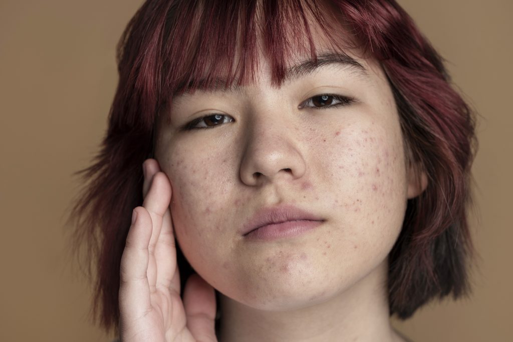 acne face