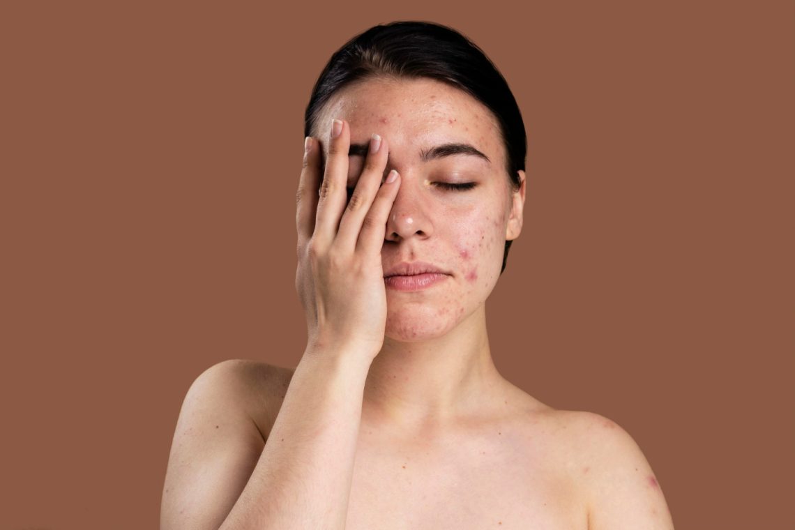 jerawat hormonal