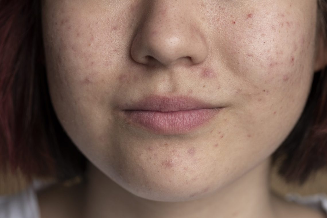 close-up-skin-pores-face-care-routine (2) jerawat bruntusan